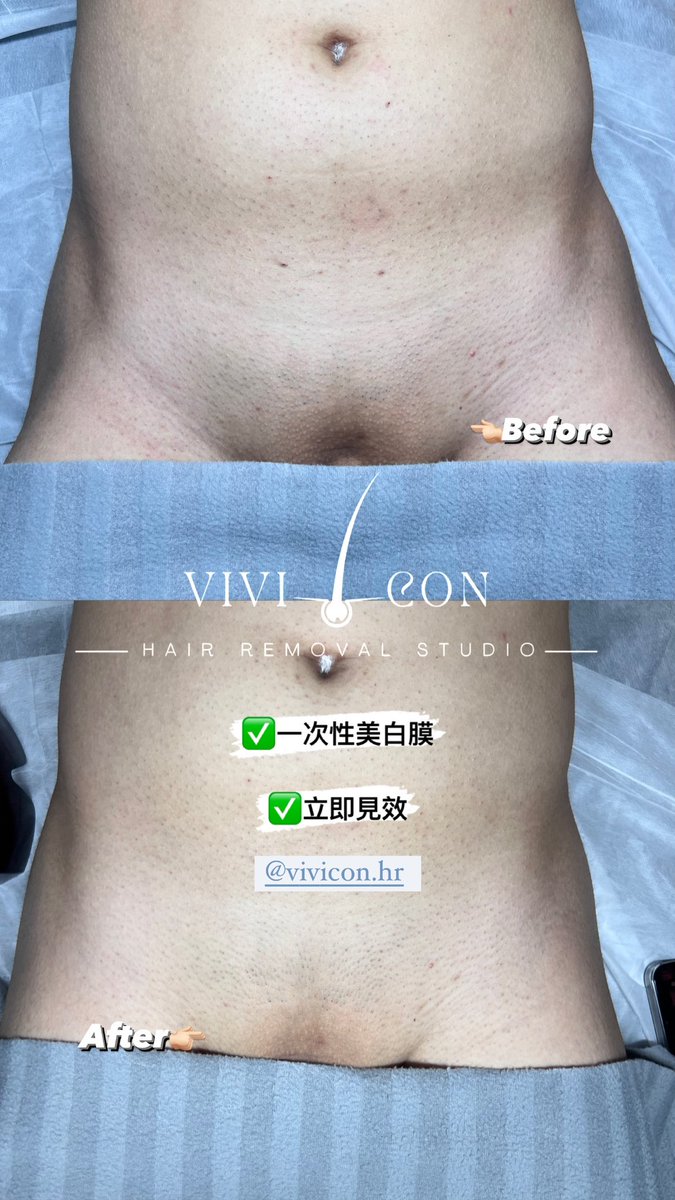 DenverHeng31676's tweet photo. ✨私密处美白膜✨

#vivicon #vivicon.hr #viviconcontactlenses 
#vivicon.my #vivicon https://t.co/H4r0s43XDU