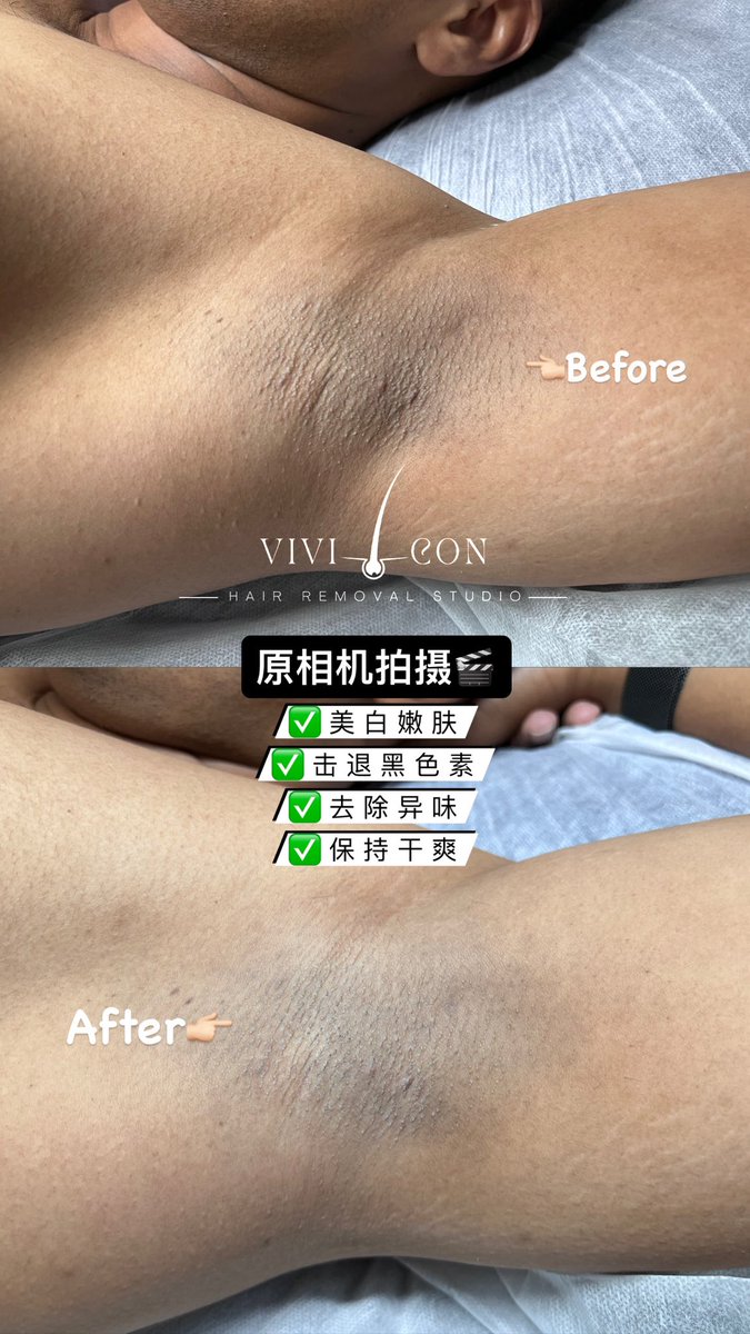 DenverHeng31676's tweet photo. ⭐️腋下美白膜⭐️ https://t.co/PANTlxiVuI