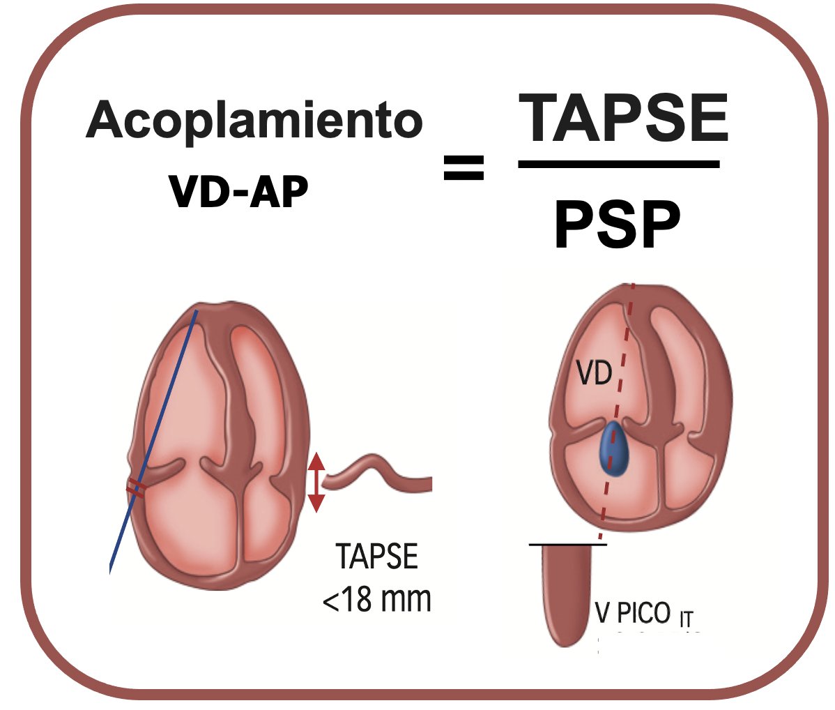 🔊El acoplamiento ventriculoarterial (ACVAD) es una medida de la capacidad del ventrículo derecho (VD) para adaptarse al aumento de la poscarga
📌ACVAD se mide con la formula TAPSE/PSP.
📌Se asocia peor pronóstico en pacientes con HAP:
🔎encuesta sobre su cálculo: