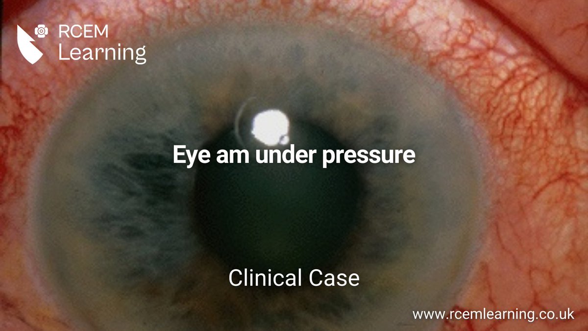 UPDATE: A 60-year-old woman presents with eye pain and visual disturbance. She vomits just as you call her in for assessment. Read our #ClinicalCase here: rcemlearning.co.uk/modules/eye-am…