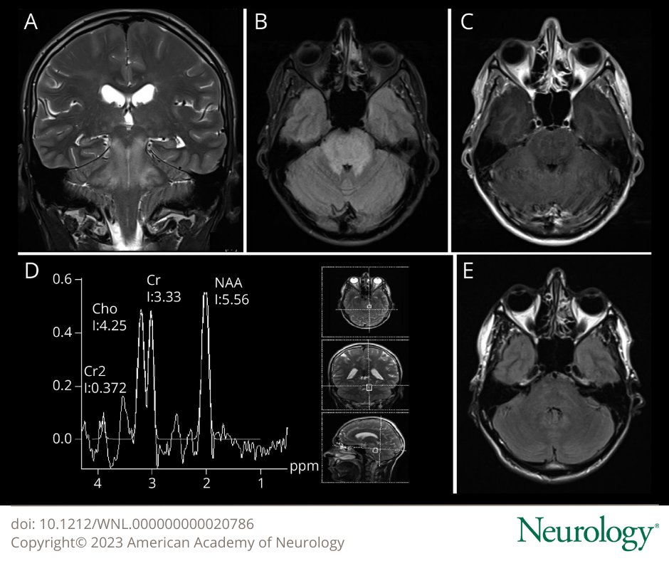 GreenJournal's tweet photo. NeuroImage: MR Spectroscopy in a Patient With Isolated Brainstem Posterior Reversible Encephalopathy Syndrome https://t.co/9E6n0Pvnf6

#NeuroTwitter #Neurology https://t.co/ZORZwBNn2Y