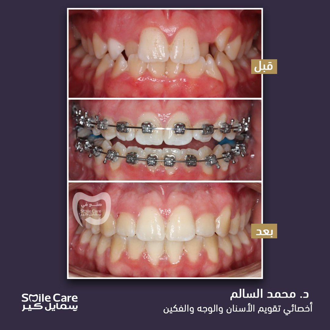 في ظل تعدد الحالات لتقويم الأسنان 
بنعرض لكم حالة مراجعة لديها عضة أمامية عكسية وأنياب دائمة مطمورة مع تزاحم في الأسنان الأمامية 
و تم علاجها باستخدام التقويم المعدني دون الحاجة للخلع🤩
 مع أخصائي تقويم الأسنان والوجه والفكين 
 د. محمد السالم | <a href="/alsalem_moh/">Mohammed Alsalem</a>