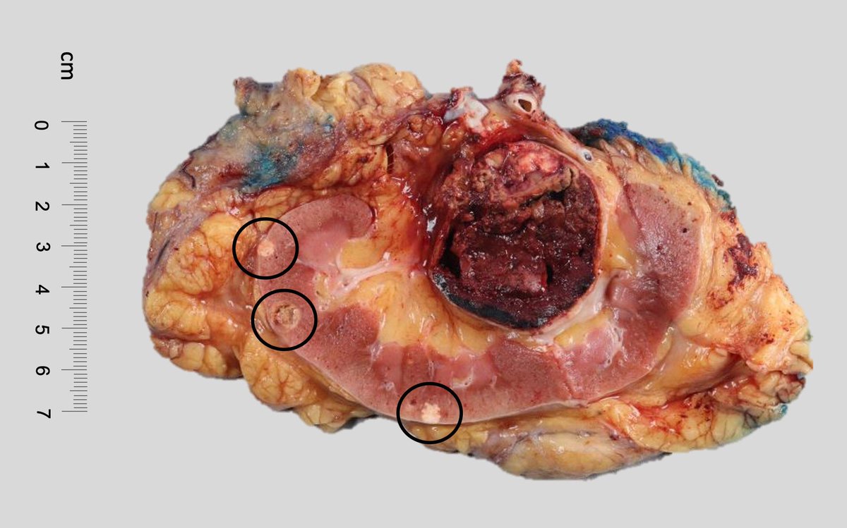 #twoforoneseries radical nephrectomy☝🏼well-circumscribed, variegated yellow-orange to red-brown, hemorrhagic mass ✌🏼incidental, irregular gray to yellow to slightly orange lesions (>15) throughout the kidney, ranging from minute to 0.8 cm in size