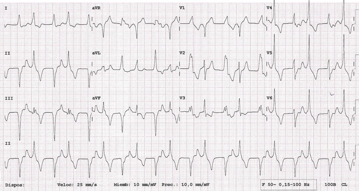 😱😱😱ECG of the week: 56 male, old inferior infarction, comes due to palpitations... our answer below, follow the thread 👇🧵