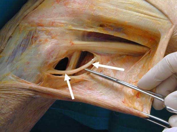 thekneedoc's tweet image. Irritation of the common #peronealnerve can occur from a direct or indirect injury, prolonged pressure such as sleeping against a car console with one’s fibular head against it, or due to instability such as instability of...medilink.us/x9hb #kneeinstability #orthotwitter