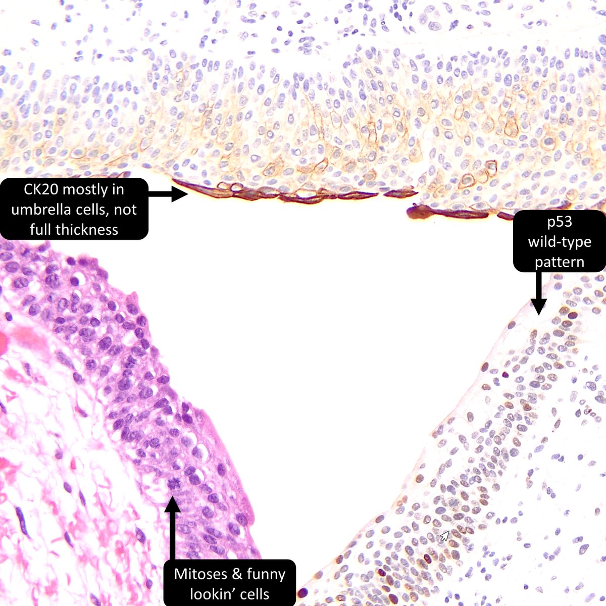 DrCycloPath's tweet photo. 50M, history of bladder cancer
Urothelial ___
A) Dysplasia
B) Atypia
#GUPath #PathTwitter #PathResidents https://t.co/MuPzs2HDh9