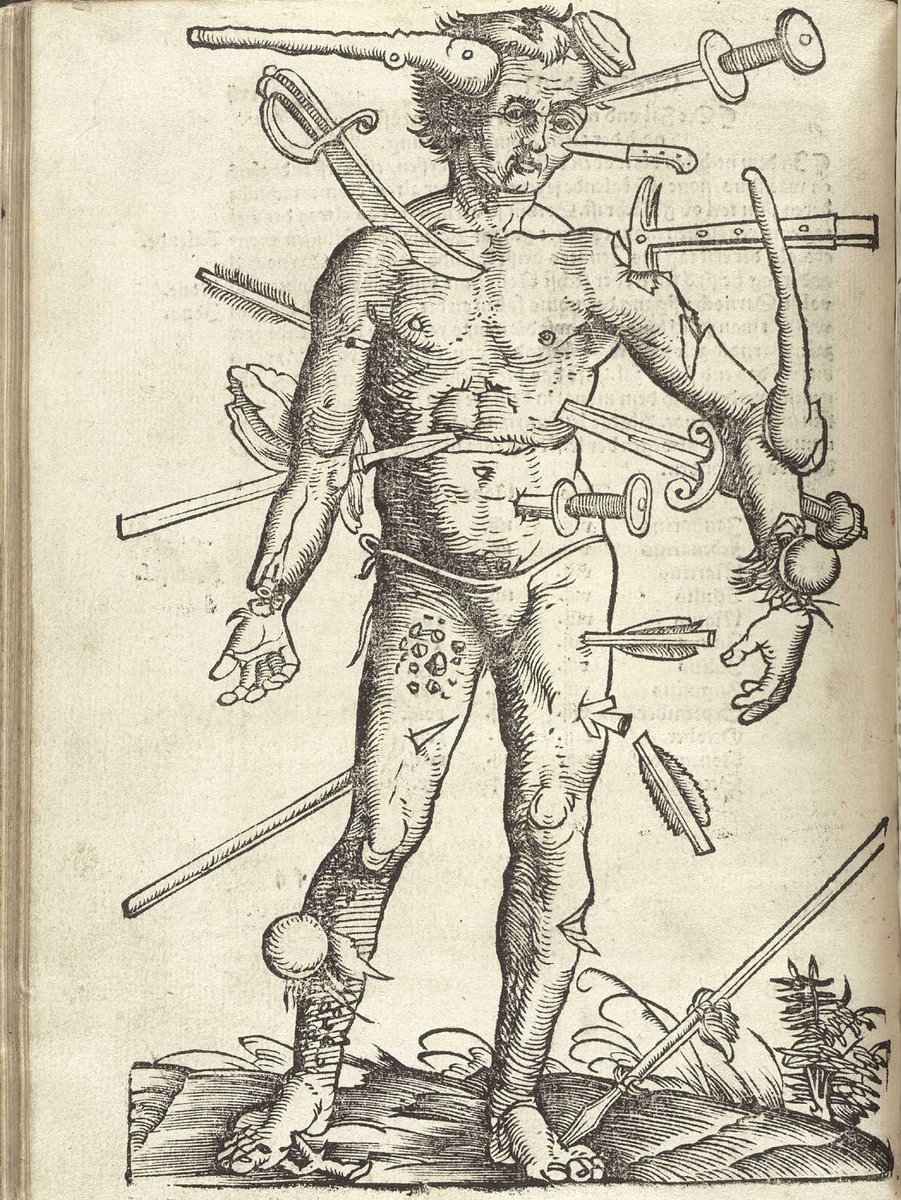 🩸 The Wound Man: A historic surgical diagram from 14th-century medical manuscripts, guiding readers through injuries and diseases with annotated details. Printed in 1491 in the Venetian Fasciculus Medicinae, it became widespread in books until the 17th century. #MedicalHistory