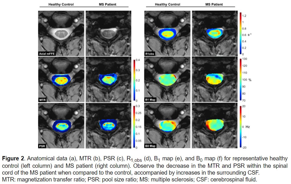MSJ (@msj_research) on Twitter photo Magnetization transfer-derived metrics on 3T MRI detect macromolecular differences in the spinal cord CSF of #MultipleSclerosis vs controls, and also associate with clinical disability.
@Mcknight1Mc <a href="/seth_smith_a/">Seth Smith</a> <a href="/vuiis/">VUIIS</a> @VUMCradiology <a href="/VanderbiltU/">Vanderbilt University</a> ▶️ journals.sagepub.com/doi/full/10.11… Magnetization transfer-derived metrics on 3T MRI detect macromolecular differences in the spinal cord CSF of #MultipleSclerosis vs controls, and also associate with clinical disability.
@Mcknight1Mc <a href="/seth_smith_a/">Seth Smith</a> <a href="/vuiis/">VUIIS</a> @VUMCradiology <a href="/VanderbiltU/">Vanderbilt University</a> ▶️ journals.sagepub.com/doi/full/10.11…