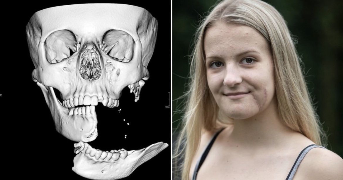 In 2019, a teenager was left with her jaw attached by just a centimetre of skin after a horror horse riding accident. Emily Eccles suffered one of the worst facial injuries her doctors had ever seen outside a war zone after an exhaust popping on a car spooked her horse. 

The