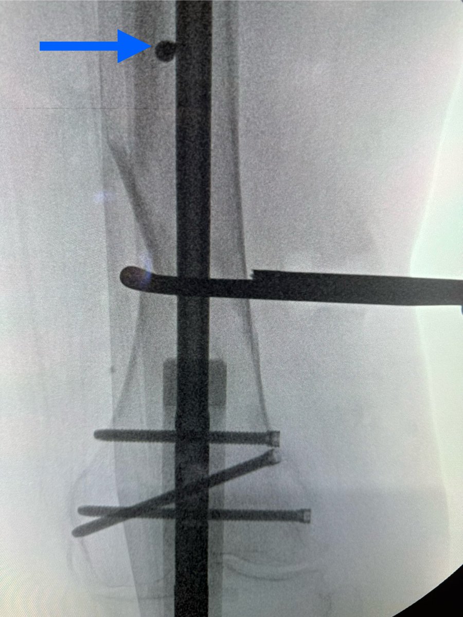 InvictaOrtho's tweet image. My example of how bell clapper screws help prevent translation deformity. Fracture aligned with clamp but when released it coronally translated (red). Reclamped &amp;amp; used bell clapper screw (blue) that narrowed proximal canal, allowing no more shift. Paper: pubmed.ncbi.nlm.nih.gov/30086037/