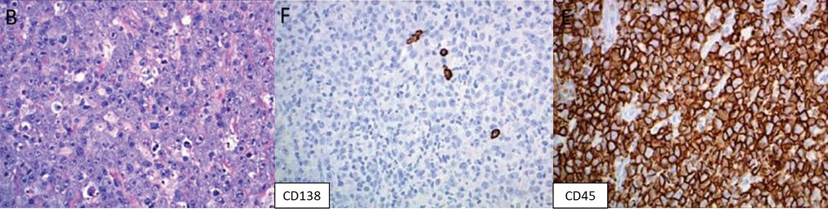 🩸CD138-negative Plasmablastic lymphoma is a very rare variant that seems to occur much more frequently as extraoral lesions, most commonly presenting as lymphadenopathies followed by gastrointestinal lesions 🩸The extraoral lesions tend to have lower HIV and EBV infection rates…