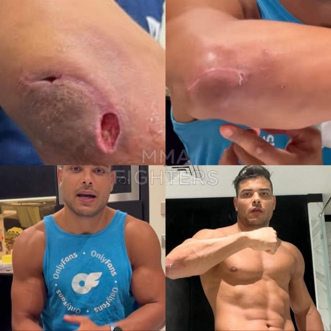 GM All 
Chúc cả nhà buổi sáng đầu tuần vui vẻ và tràn đày ' NĂNG LƯỢNG'.
Những chấn thương của võ sĩ MMA chuyên nghiệp rất nặng , nhiều trường hợp có thể ảnh hưởng đến tính mạng.
Chấn thương của Paulo Costa.
Xin ae 1 FOlo, CMt ,tt nhé . Thank You.