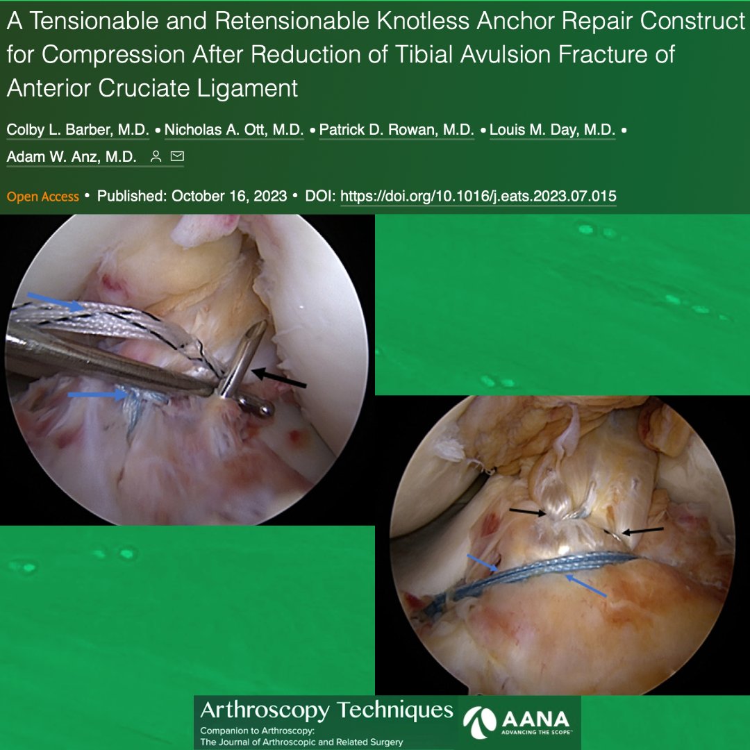 New technique paper on a tensionable and retensionable construct that uses knotless anchor fixation to produce compression after anatomic reduction of a tibial avulsion fracture! ow.ly/ihpc50Q69nm @AdamAnzMD @AndrewsInst, @andrews_REF #Tibia #Avulsion #Sports #Knee