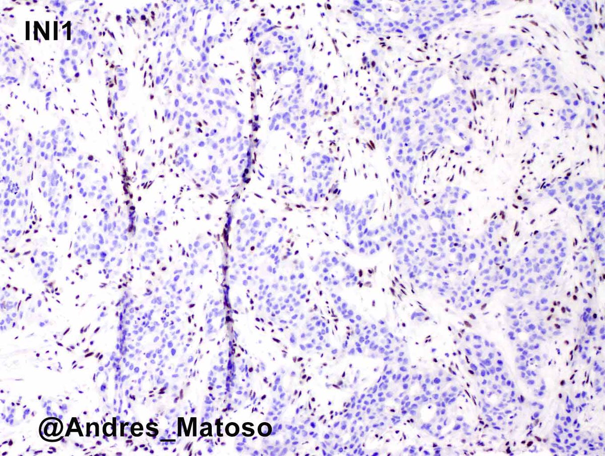 Here is its liver metastasis showing loss of INI1 expression. Associated with sickle cell trait/disease.