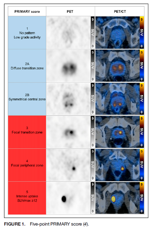 radiolobt's tweet photo. Reproducibility and Accuracy of the PRIMARY Score on PSMA PET and of PI-RADS on Multiparametric MRI for Prostate Cancer Diagnosis Within a Real-World Database https://t.co/oGe7a1EJPK 
#prostatecancer #CancerResearch #MolecularImaging https://t.co/1cm5t9aoc5