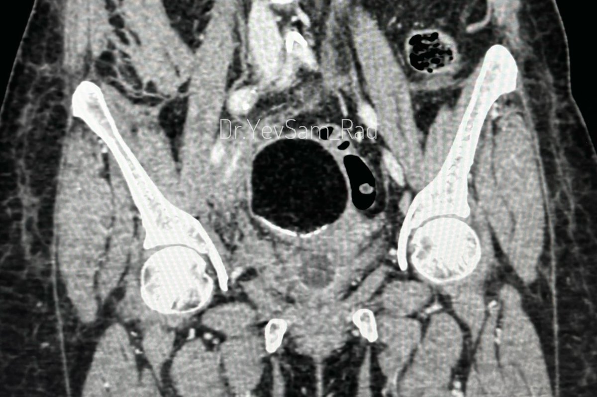 Dr.Yevvari Sameera (@dryevsam_rad) on Twitter photo #Fatmyfriend Learnt how to use Fat to navigate through the world of Radiology/Imaging for the first time from <a href="/dandamudivasu/">Srinivas Dandamudi</a> sir years back. It is now a daily practice to look at how fat is, in and around the image which greatly helps in diagnosis.
#Basics
#Pelvicimaging
#RadX #Fatmyfriend Learnt how to use Fat to navigate through the world of Radiology/Imaging for the first time from <a href="/dandamudivasu/">Srinivas Dandamudi</a> sir years back. It is now a daily practice to look at how fat is, in and around the image which greatly helps in diagnosis.
#Basics
#Pelvicimaging
#RadX