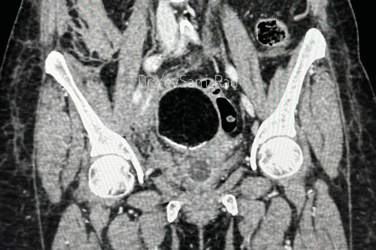 #Fatmyfriend Learnt how to use Fat to navigate through the world of Radiology/Imaging for the first time from @dandamudivasu sir years back. It is now a daily practice to look at how fat is, in and around the image which greatly helps in diagnosis. #Basics #Pelvicimaging #RadX