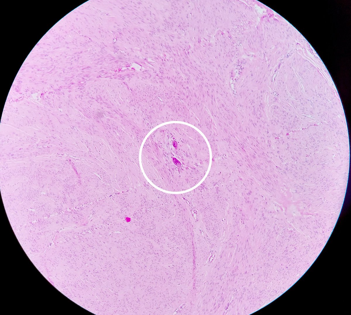 #BeautyInTheBenign #leiomyoma with osteoclastic giant cells. #PathTwitter #gynpath pubmed.ncbi.nlm.nih.gov/26166717/