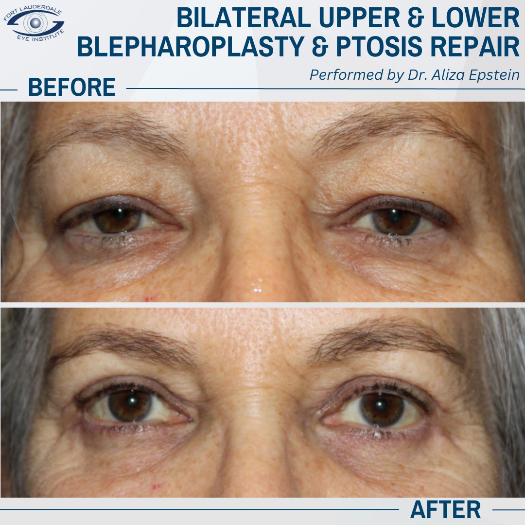 fleieye's tweet photo. Dr. Aliza Epstein performed a ptosis repair of the upper lids &amp; blepharoplasty of the upper and lower lids, and now this patient has an improved range of vision and a rejuvenated appearance. Schedule your consultation today at https://t.co/cBHRmT9XBM or by calling (954) 741-5555. https://t.co/E4iXdtjlTT
