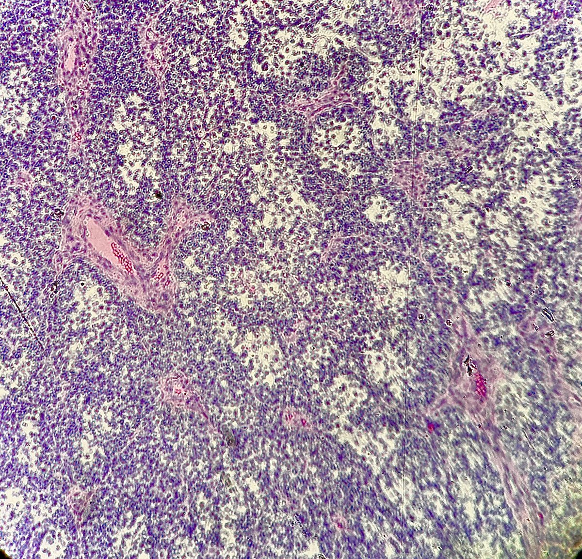 Path4People's tweet photo. 15 y/o M with head and neck tumor
+ lymphatic spread
Fish reveals a t(2;13) PAX3-FOXO1 translocation.
Dx?
#pathagonia #pathx #pathology #pedsx #hemeonc #surgery #pediatrics #medx #medicine #pedssurgery #hemex https://t.co/0axvWUKNyO