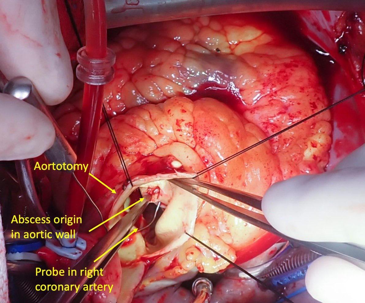 Atypical presentation for native AV Endocarditis causing abscess above RCA, treated with AVR, abscess unroofing, and patch repair of the aortic root #CCEndocarditis evidence.nejm.org/doi/abs/10.105…