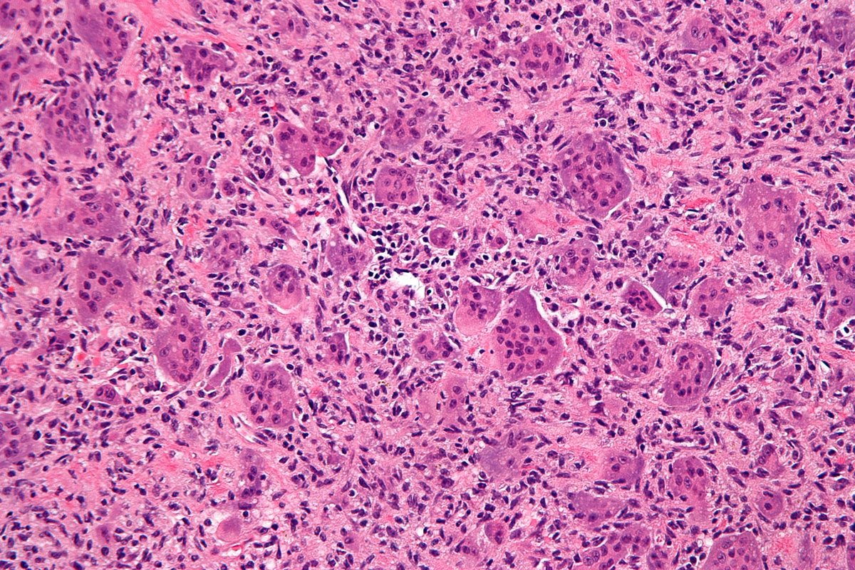 BCRT's tweet photo. Giant Cell Tumour of the Bone Awareness Week is here!
Please help us spread the word far and wide to raise awareness of this rare, one-in-a-million disease π§«
Find out more in our new research strategy: https://t.co/pTZIPmP43b
#GCTB #Awareness #UntilTheresACure https://t.co/IqUQkEFZU7