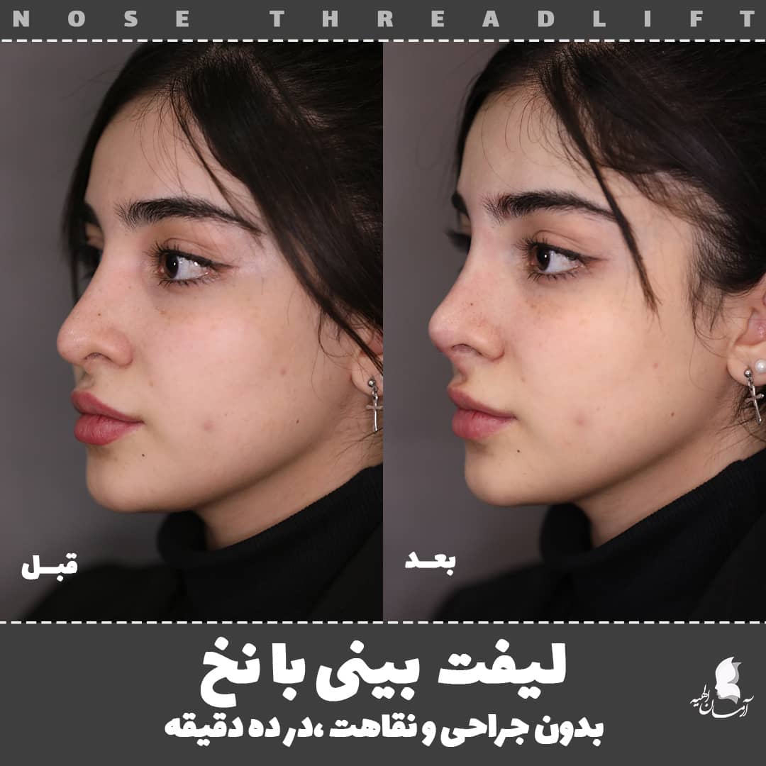 Arman_elahie's tweet image. اگر به دنبال نتیجه فوری هستید؛
اگر به هر دلیلی نمی خواهید عمل بینی انجام دهید؛
یا شرایط گذراندن دوران نقاهت طولانی مدت ندارید؛ 
پیشنهاد ما لیفت بینی با نخ در کمتر ده دقیقه است.
#لیفت_بینی #لیفت_بینی_با_نخ 
#nosethreadlift #nosejob