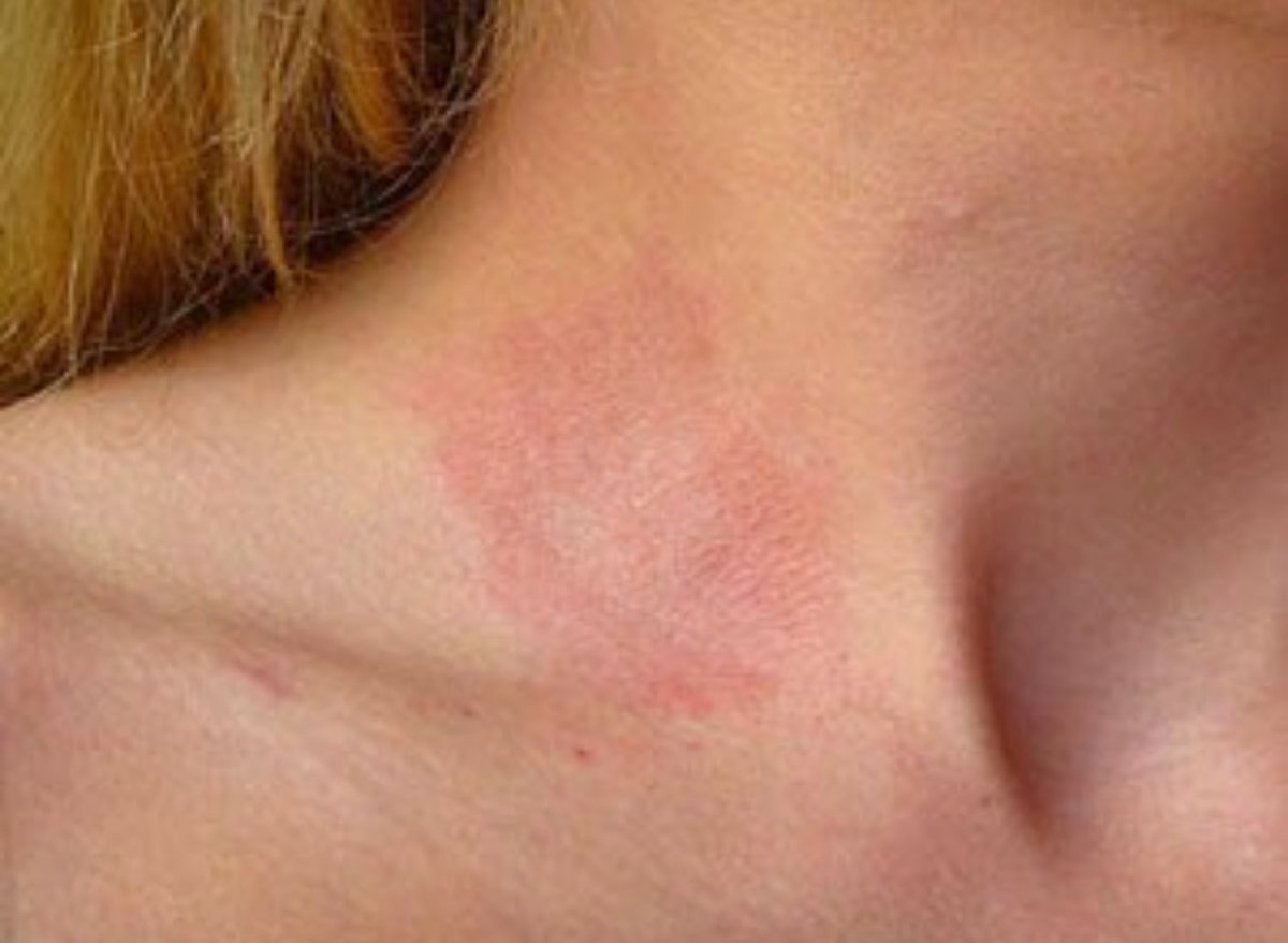 معظم العطور قد تسبب حساسية تلامسية للجلد عند البعض تعرف باسم allergic contact dermatitis خصوصاً اذا تم رشها بشكل مباشر على الجلد ، لذلك من الافضل رش العطور على الملابس وليس على