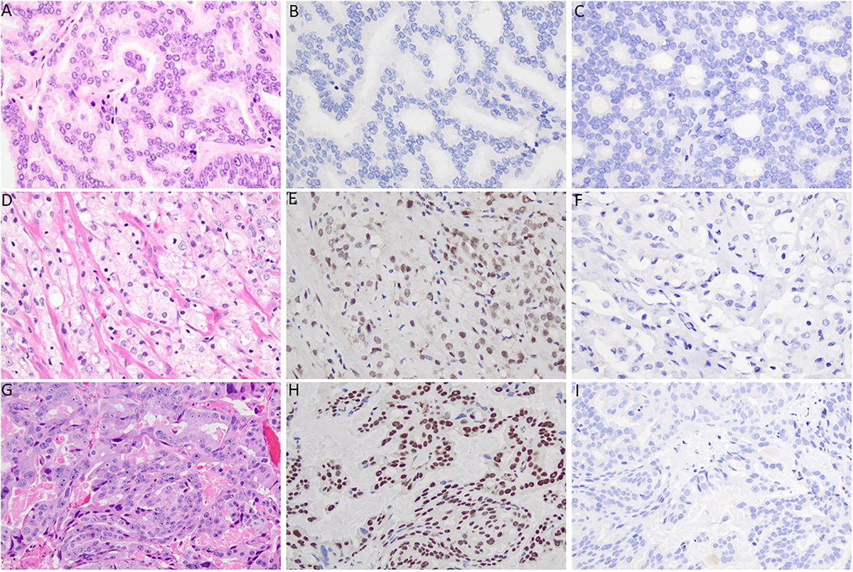 New in #HumPathol: TRPS1 expression in primary and metastatic prostatic adenocarcinoma, muscle invasive bladder urothelial carcinoma, and breast carcinoma: Is TRPS1 truly specific and sensitive for a breast primary? sciencedirect.com/science/articl… #pathology #PathTwitter #breastpath