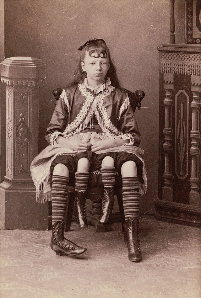 Past To Present Stories (@past2present_x) on Twitter photo <a href="/Morbidful/">Morbid Knowledge</a> Josephine Myrtle Corbin (1868-1928) was an American woman, who was a sideshow performer born a dipygus. This referred to the fact that she had two separate pelvises side by side from the waist down, as a result of her body axis splitting as it developed. Each of her smaller inner <a href="/Morbidful/">Morbid Knowledge</a> Josephine Myrtle Corbin (1868-1928) was an American woman, who was a sideshow performer born a dipygus. This referred to the fact that she had two separate pelvises side by side from the waist down, as a result of her body axis splitting as it developed. Each of her smaller inner