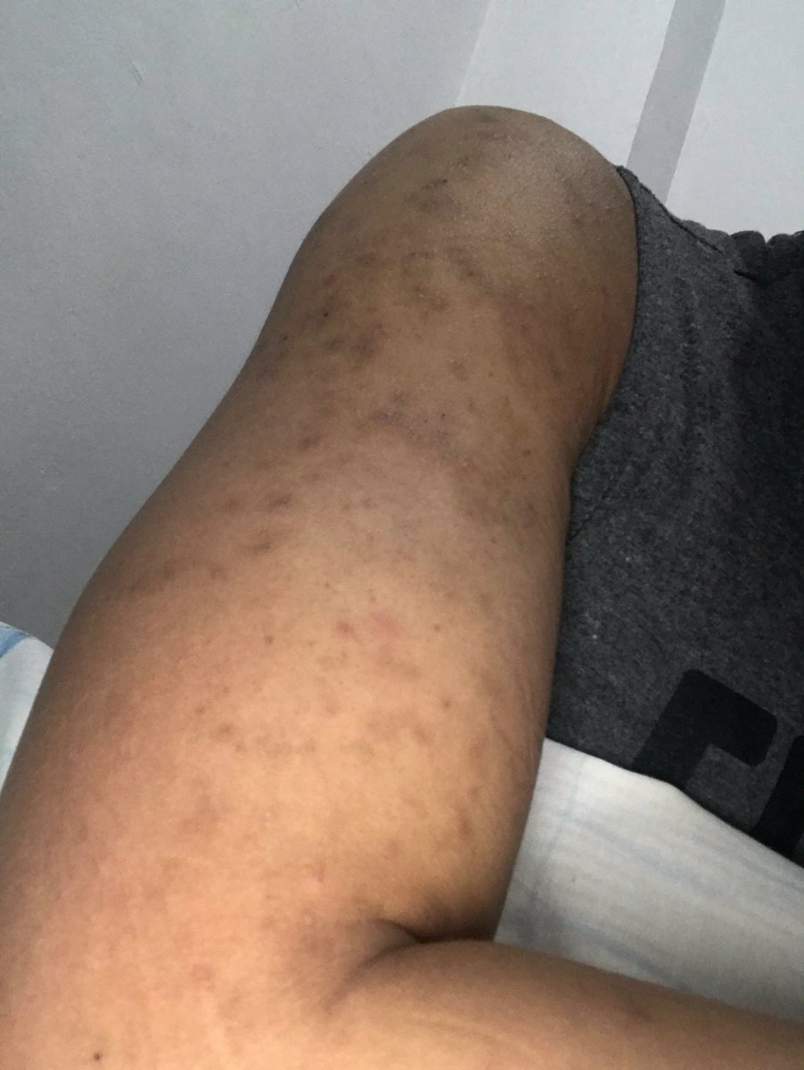 don_bran0386's tweet photo. 2019 vs 2023

Newly diagnosed peeps, this is a reminder that ARV works. As explained by my ID before, pag bago ka lang sa ARV, parang merong war sa loob ng katawan mo, ARV vs Virus, and it may manifest into skin conditions. But trust that it will get better in time🙏. https://t.co/4a75Zk4ekU