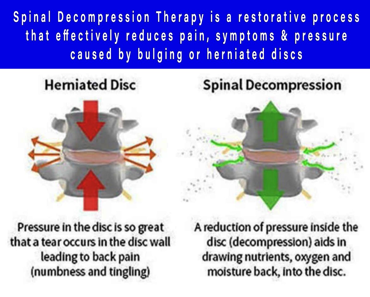 TriangleDecompr's tweet image. Bulging or herniated discs can cause substantial pain &amp;amp; disability, significantly impacting overall quality of life. Fortunately, Triangle Spinal Decompression presents a non-invasive &amp;amp; highly effective solution.
#spinaldecompressiontherapy #backsurgery #spinesurgery #slippeddisc