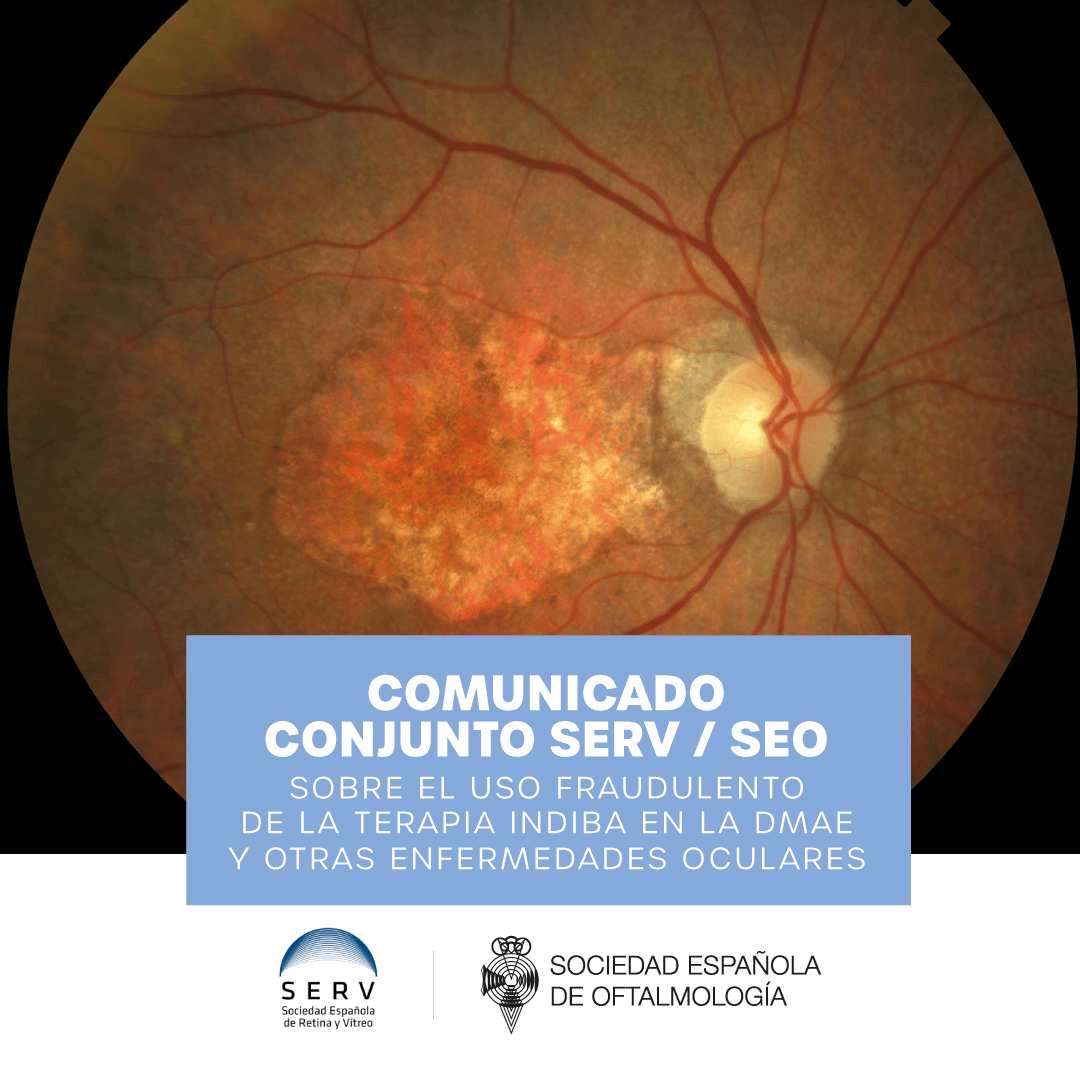 COMUNICADO CONJUNTO SERV / SEO SOBRE EL USO FRAUDULENTO DE LA TERAPIA INDIBA EN LA DMAE Y OTRAS ENFERMEDADES OCULARES

🧐Consulta aquí el comunicado completo: bit.ly/3uEU7Ad

#DMAE #Indiba #pseudoterapia #médicosoftalmólogos #oftalmología