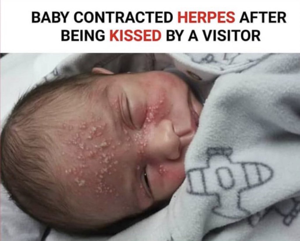 FirstDoctor's tweet image. Never let people kiss your baby on the lips or face even if it's just a peck. A baby's immune system is not as strong as that of adults, they can easily come down with infections such as herpes.