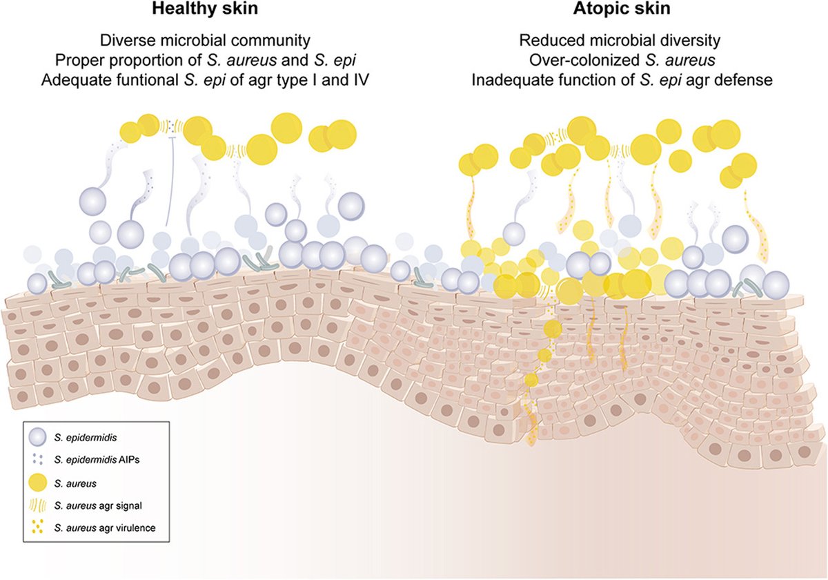"Heterogeneous regulation of Staphylococcus aureus by different Staphylococcus epidermidis agr types in atopic dermatitis" doi.org/10.1016/j.jid.… #JIDJournal #dermscience #dermtwitter