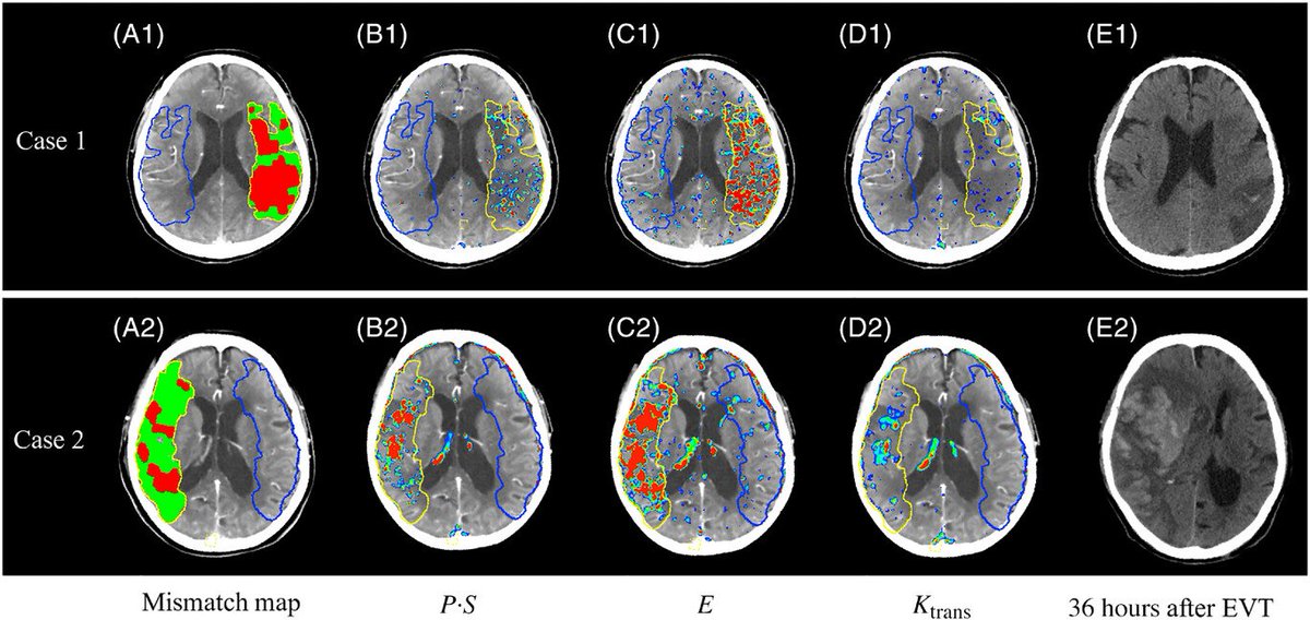 Could you have predicted hemorrhage after #thrombectomy in this #stroke? Read below to find out how with #neuroimaging from CT #perfusion. #ICU #neurology #neurotwitter #neurosurgery #brain #neurovascular #radres #neurorad #futureneurologist #neuromatch onlinelibrary.wiley.com/doi/10.1111/jo…