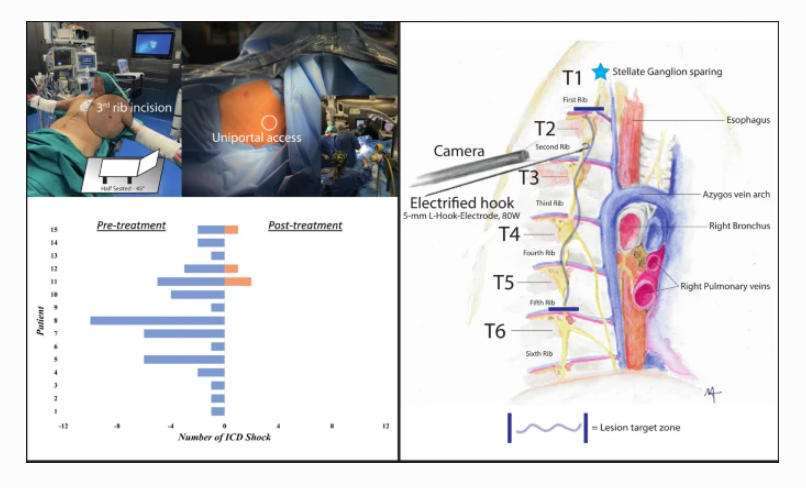 JICE (@jice_ep) on Twitter photo 🚨New #FreeRead Article in
<a href="/JICE_EP/">JICE</a>
Modified Sympathicotomy in Patients w/ Refractory Ventricular Tachycardia & Structural Heart Disease: Single-Center Experience
by <a href="/FilippoCauti/">Filippo Maria Cauti</a> <a href="/PietroRossiEP/">Pietro Rossi</a> <a href="/stefbianchi/">Stefano Bianchi</a> <a href="/dogi84md/">Domenico Giovanni Della Rocca, MD</a> M Anille & Colleagues
📖🧐rdcu.be/dsKvH
#EPeeps 🚨New #FreeRead Article in
<a href="/JICE_EP/">JICE</a>
Modified Sympathicotomy in Patients w/ Refractory Ventricular Tachycardia & Structural Heart Disease: Single-Center Experience
by <a href="/FilippoCauti/">Filippo Maria Cauti</a> <a href="/PietroRossiEP/">Pietro Rossi</a> <a href="/stefbianchi/">Stefano Bianchi</a> <a href="/dogi84md/">Domenico Giovanni Della Rocca, MD</a> M Anille & Colleagues
📖🧐rdcu.be/dsKvH
#EPeeps