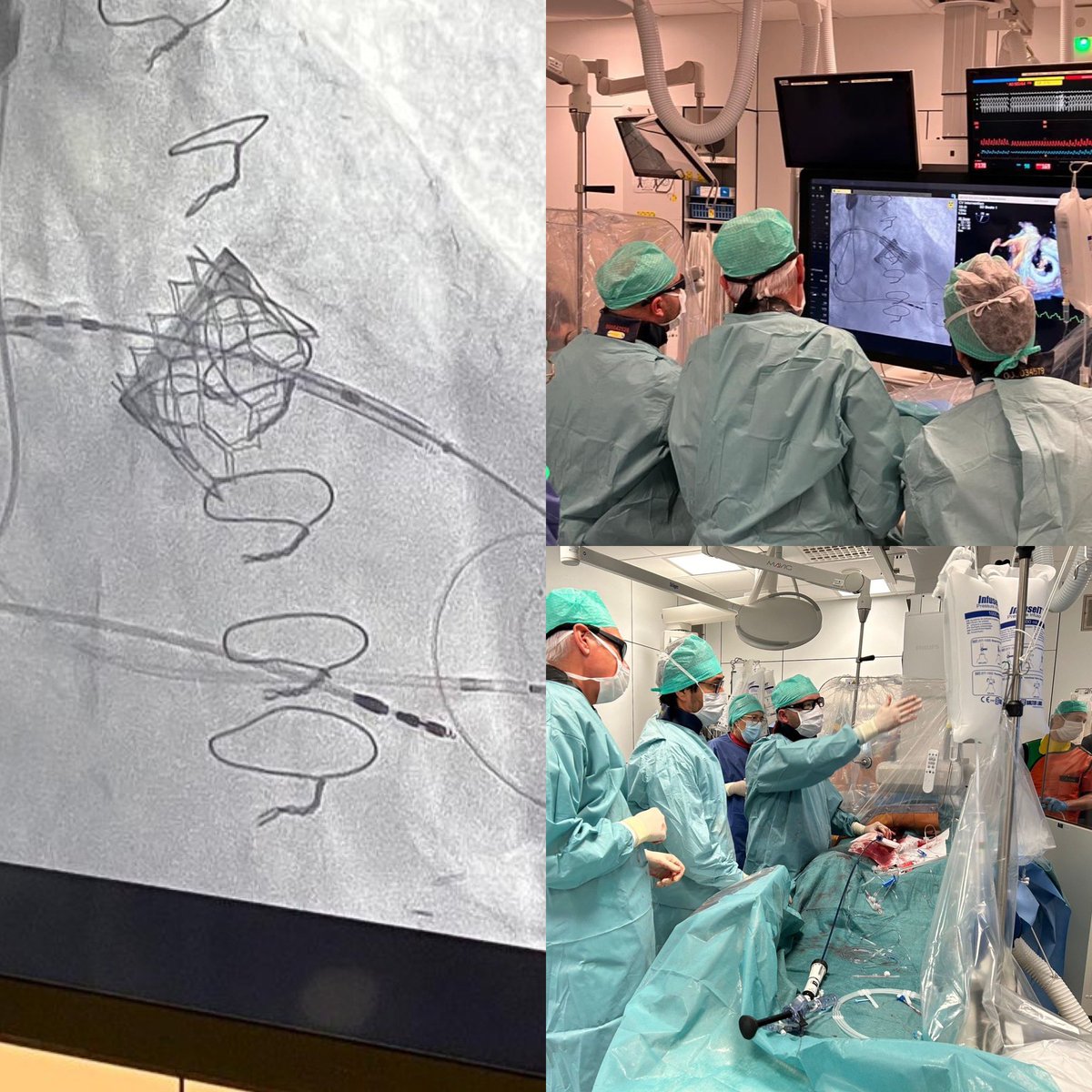 @UZBrussel continuously striving to offer minimal invasive solutions: proud of our cathlab team who performed their first successful mitral ValveInValve procedure(EdwardsSapien3valve)in a patient with a degenerated mitral bioprosthesis
#proudtobebrussels #CHVZ #structuralheart