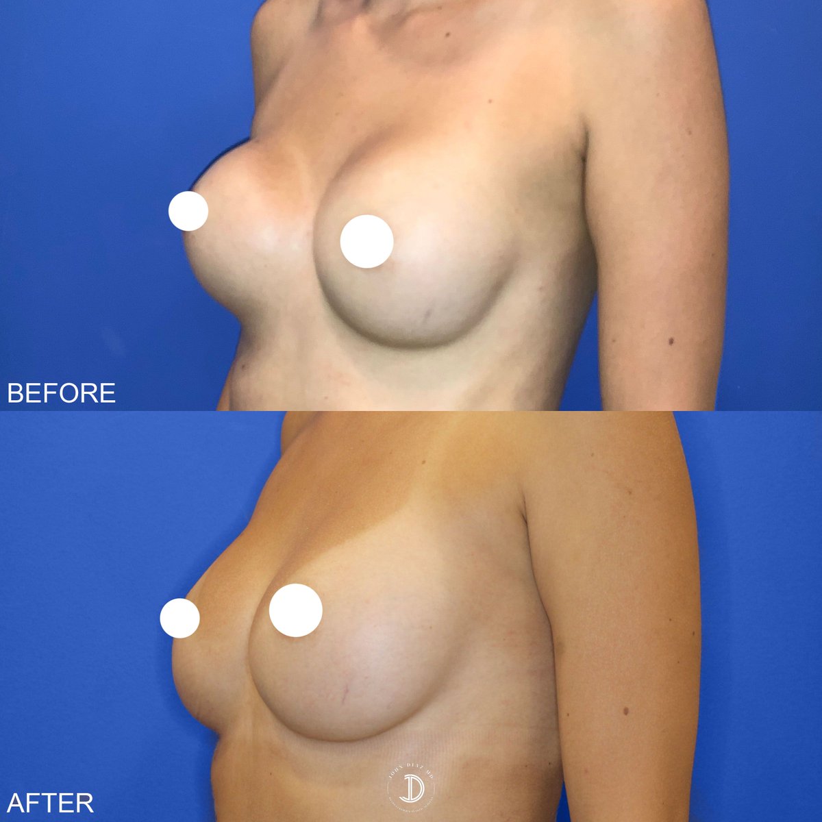 Breast Revision