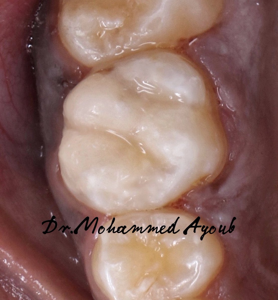 i_edx's tweet photo. Tooth #16
Indirect pulp capping with MTA followed by Composite  cusps build up. https://t.co/gXTD281G4a