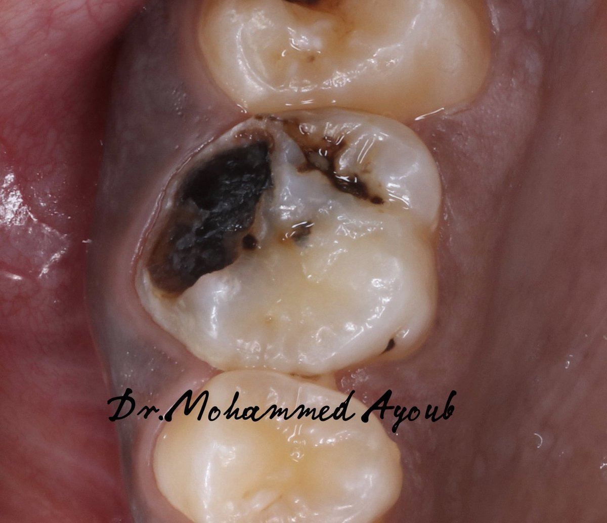 i_edx's tweet photo. Tooth #16
Indirect pulp capping with MTA followed by Composite  cusps build up. https://t.co/gXTD281G4a