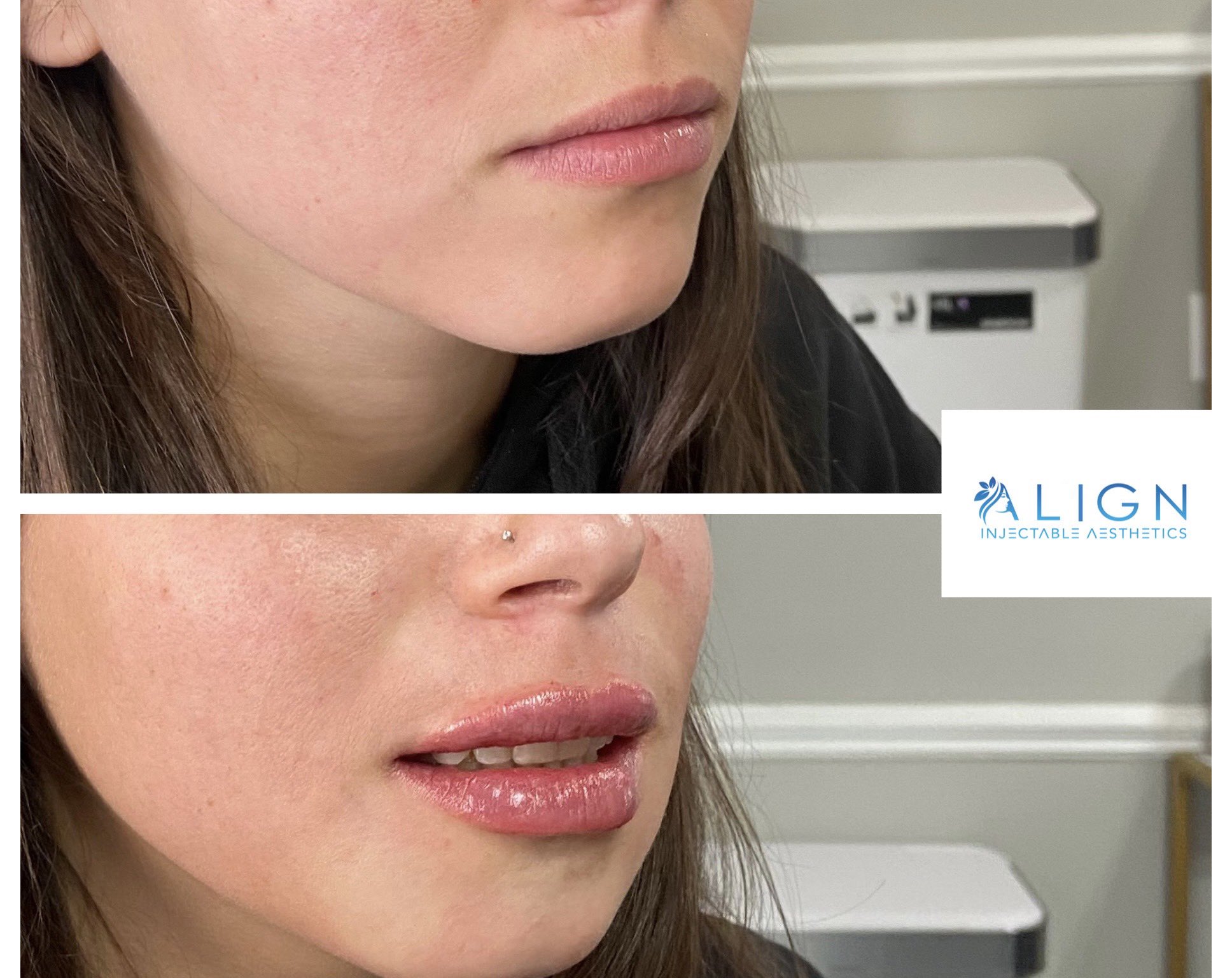 FAQ: LIP INJECTIONS  Align Injectable Aesthetics