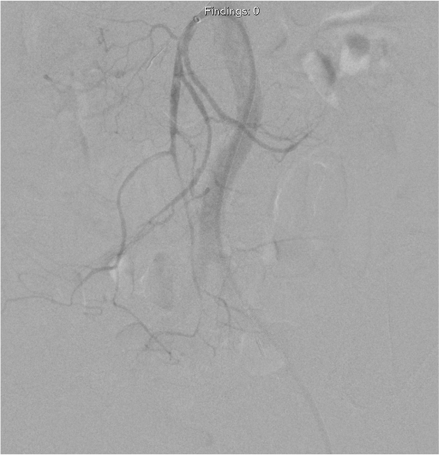 We not only close bleeding vessels but also open them if they are blocked. Guess what the underlying etiology was and what I used! @PenVascular @CERENOVUS_HQ @SIRspecialists @SIR_ECS @cirsesociety @VESurgery @Georgetown_IR @IR_UMMC @CHICKVIR @TheRealDoctorOs @JuliusChapiro