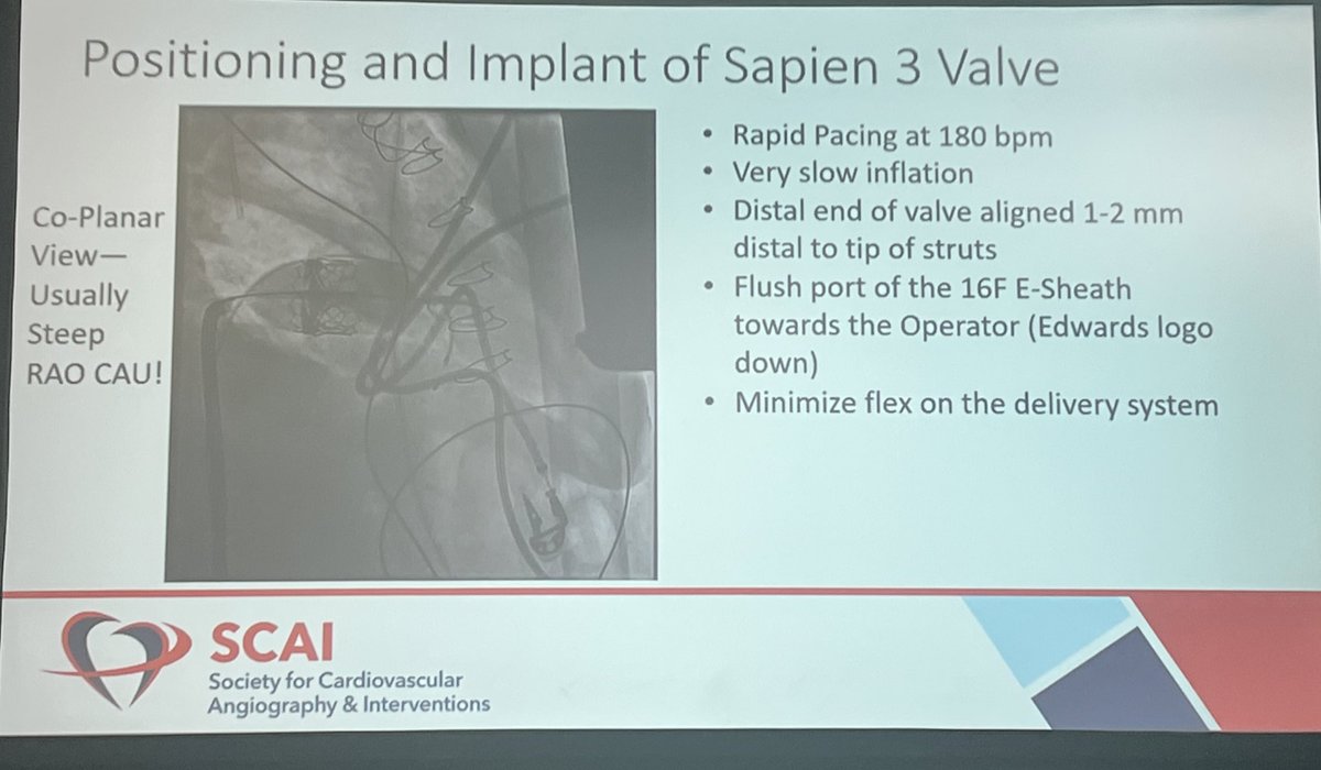Terrific talk by Dr. @DrJMessenger @SCAI on safety/efficacy of SAPIEN3🫀 mitral ViV in pts at prohibitive surgical risk for redo #MVr. Pre-ViV planning enhanced by CT, assessment of T-ID & neo-LVOT to predict risk of LVOTo; 5-yr data from MITRAL trial has shown 80% survival #SCAI