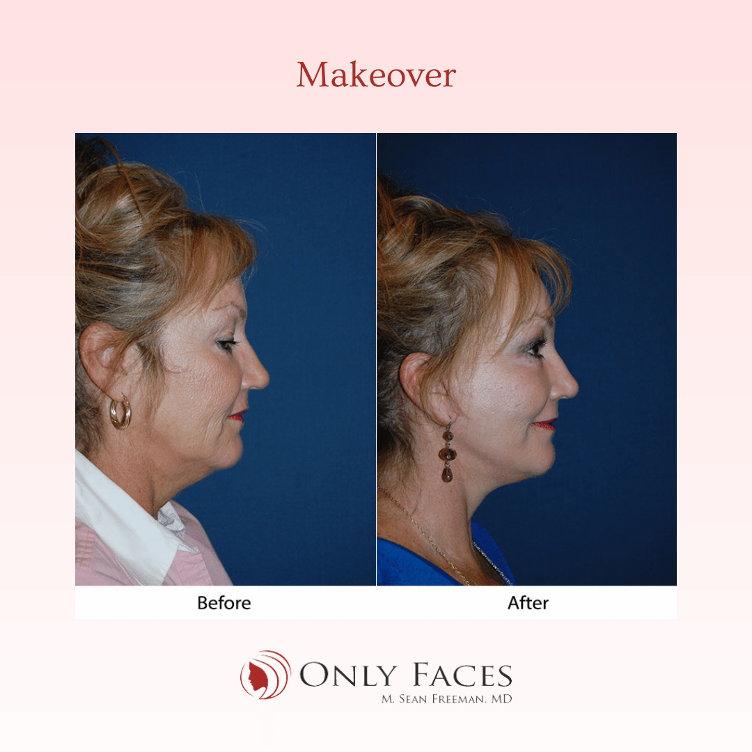 OnlyFacesCLT's tweet photo. This 51-year-old is post-op from a Segmental Endoscopic #BrowLift: lateral-R, 3/4-L, Deep Plane #MiniTuck, Lower lid: SOOF lift #blepharoplasty, and Ablative CO2 laser resurfacing of the eyes and mouth. #Makeover https://t.co/iJCGvGzvaR