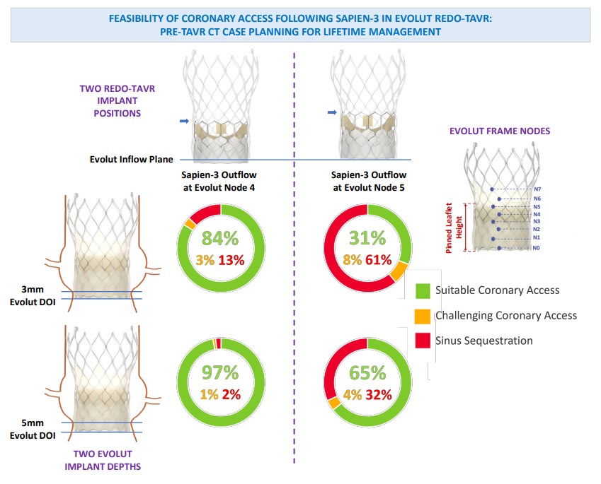 Feasibility of coronary access following TAVR. CT predicted coronary access @HarryDauerman @BlankePhilipp @Mo_A_W @G_Tarantini01 @KendraGrubb @paulmahoneyMD @CJChungMD @GilbertTangMD #AHAJournals #cardiotwitter ahajrnls.org/3t2AeTn