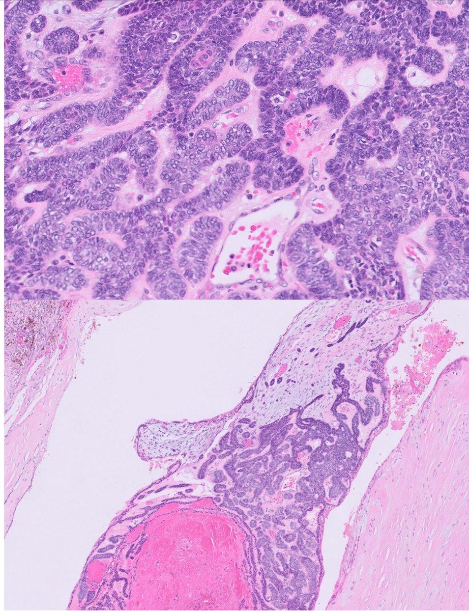 Jaw mass #aurgpath #pathtwitter #pathology #pathologyfamily @MayoPathology @GeronimoJrLapac @Kenny92954457