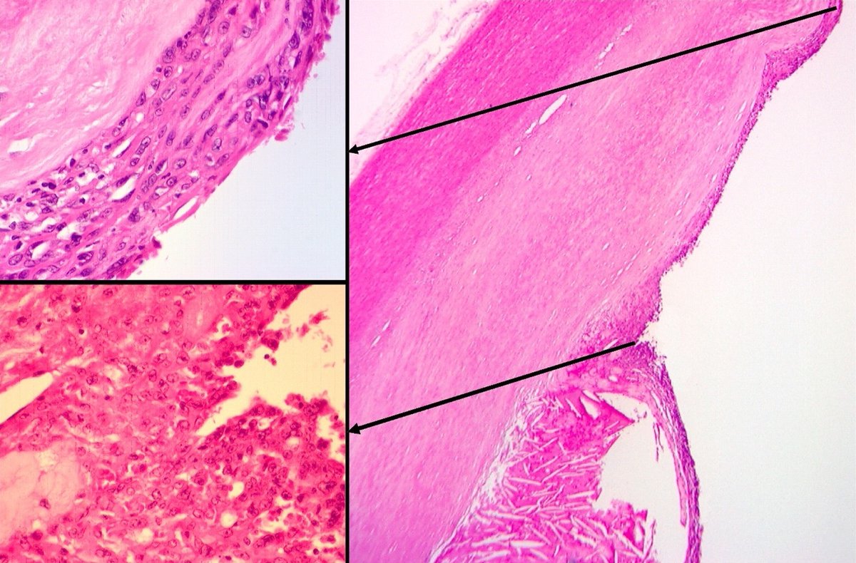 Soft tissue tumor - what's your diagnosis?
Topic link: shorturl.at/alsC0
Contributed by Matjaz Sebenik, M.D. and Marietta Kintiroglou, M.D.

#images #softtissue #BSTpath #PathTwitter #diagnosis #tumor #Cancer #CancerResearch #curingcancernetwork
