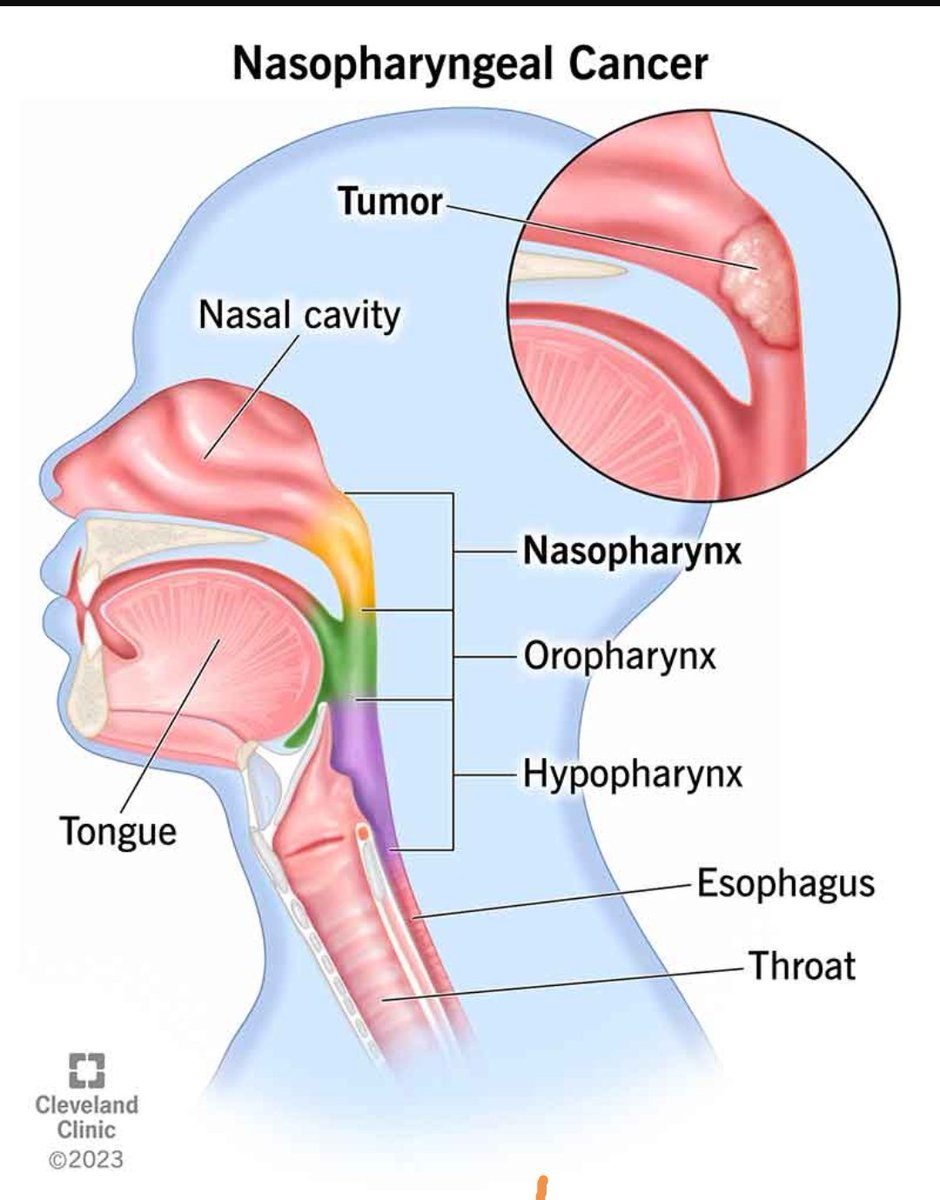 Nasopharyngeal Carcinoma watch the video below to know more about it's risk factors signs and symptoms and treatment options.

youtu.be/UJwhaX7ovjI?si…

#thecancerdoctor #Mpesa #CancerAwareness #Elnino #nasopharyngealcancer #NPC #Elnino