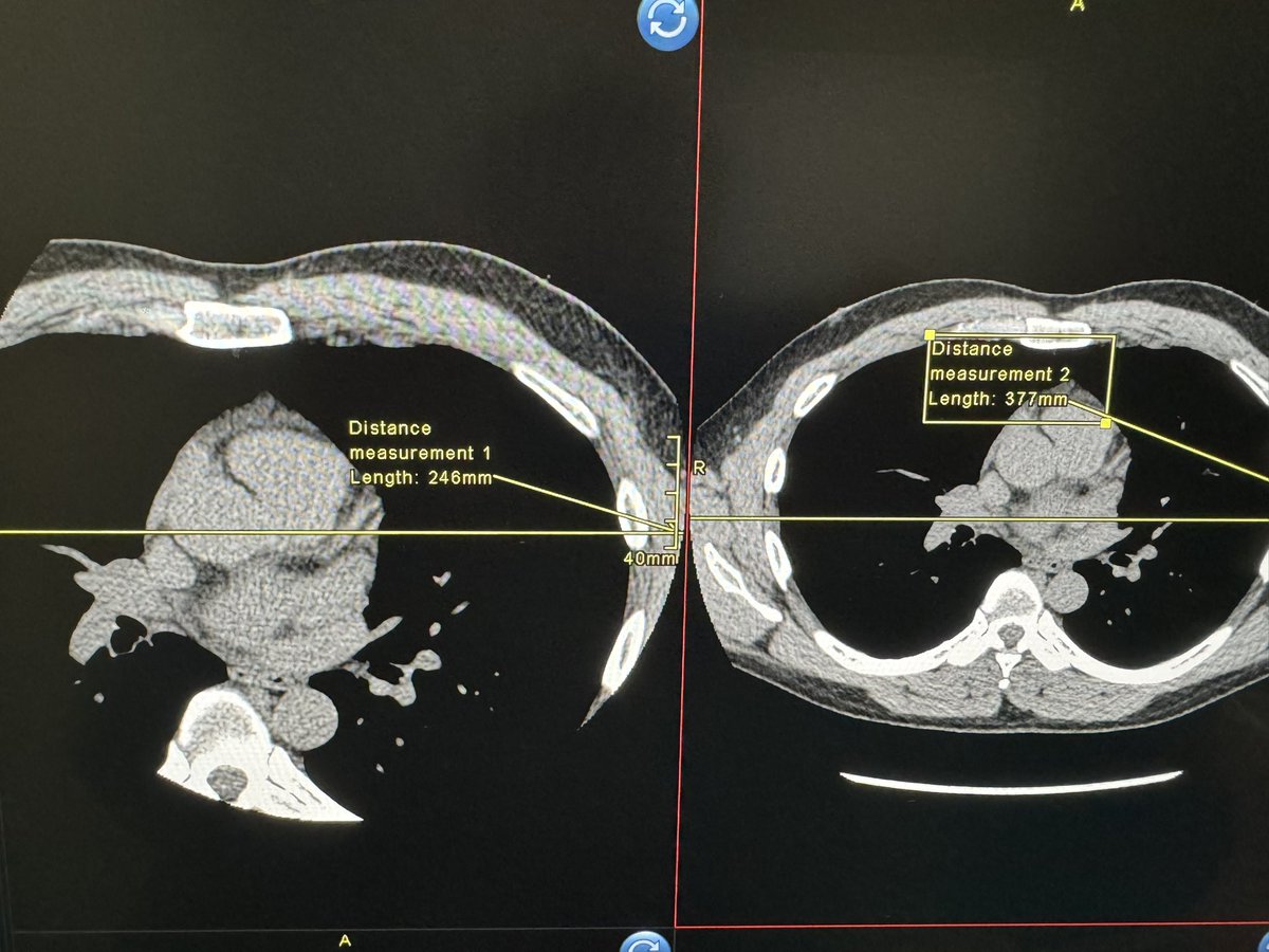 Giovanni_Lorenz's tweet photo. What is a CT Calcium Score?

🫀This is a non contrasted gated CT Chest exam for risk prediction

🫀If you have chest pain, the 1A recommendation is a CT Angiogram of the coronary arteries (see my last post on how to knock out 30 in an afternoon). 

🫀Acquired in late diastole around 75% of cardiac cycle, in a low dose technique (less than 300mGy)
🫀Displayed in a soft tissue window. 

Now what’s sneaky is that this isn’t a unique acquisition…this is literally a CT Chest WO (gated).

🫀The tech artificially coned down, centers at the heart with a 26cm ish wide FOV in a 256 matrix to make the pixel: attenuation isometric work for unit less scoring (Agatson). 

🫀In most centers you do this during the  “shoulder” hours of ops, early morning or late evening en masse. 

🫀No prep, no meds. 

🫀Depending on how fast your tech or Rad is on finalizing the report, you can preprocess on the PACS or have the tech circle the calcium and calculate the Calcium burden for low-intermediate risk determination for statin use. 

Have fun!